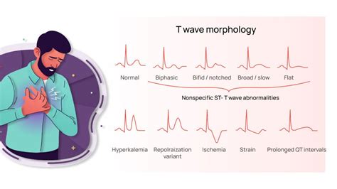 nonspecific t wave abnormality|st&t wave abnormality reason for concern.